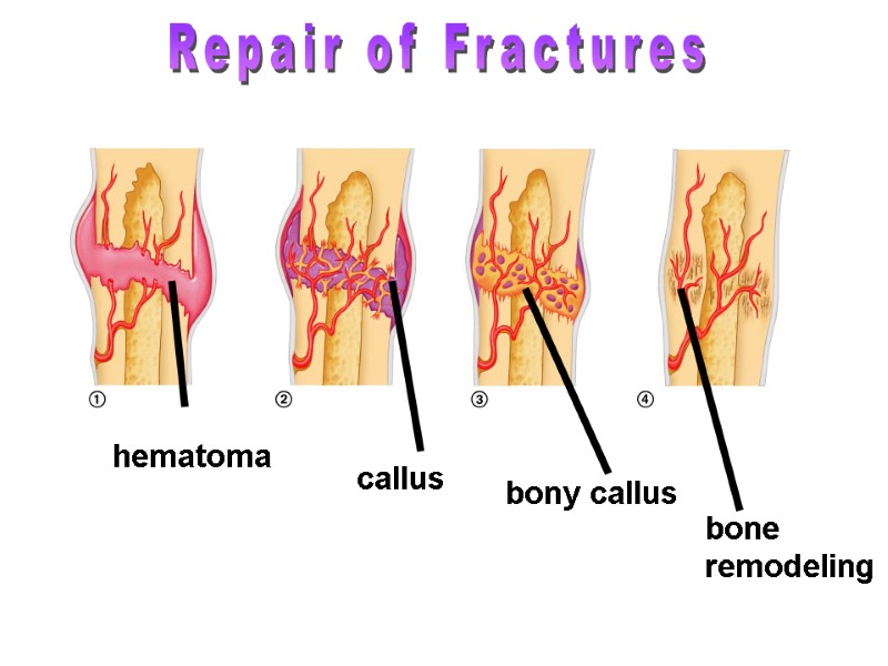>hematoma callus bony callus Repair of Fractures bone  remodeling